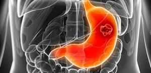 Перстневідноклеточний рак шлунка: форми цієї карциноми, симптоми, прогноз