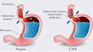 pH-метрія шлунка: підготовка і проведення дослідження