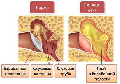 Писк в вухах і голові: причини і лікування