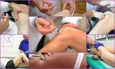 Плазмоліфтінг суглобів (колінного, тазостегнового): відгуки, опис процедури, вартість