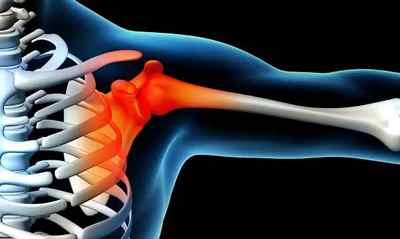 Плескіт: причини, симптоми і лікування плечового нерва