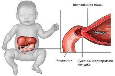 Пілоростеноз у новонароджених: симптоматика, діагностика і лікування