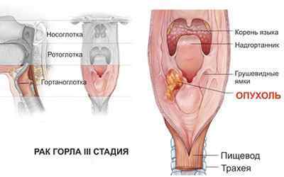 Плоскоклітинний рак гортані: стадії, лікування