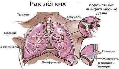 Плоскоклітинний рак легені: форми, стадії, прогноз