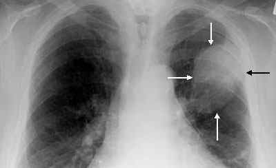 Плоскоклітинний рак легені: форми, стадії, прогноз