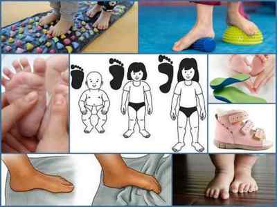 Плоскостопість у дітей - лікування в домашніх умовах