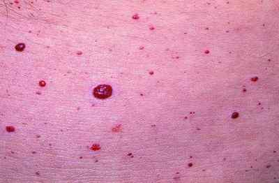 Плями на шкірі при захворюваннях підшлункової залози, види шкірних висипань на тілі, фото