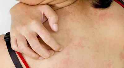 Плями на шкірі при захворюваннях підшлункової залози, види шкірних висипань на тілі, фото