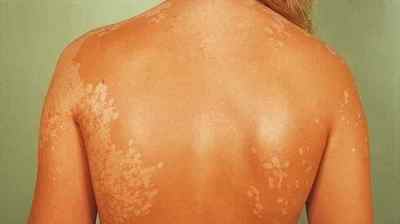 Пляжний грибок на шкірі: лікування та профлактіка