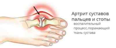 Плюснефаланговийсуглоб: лікування артрозу 1 пальця стопи 1 і 2 ступінь і остеоартрозу, запалення | Ревматолог