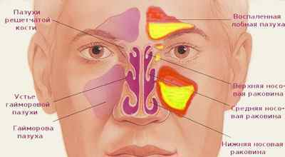 Пневматизація пазух носа: що це таке