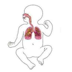Пневмонія у недоношених новонароджених: причини, особливості