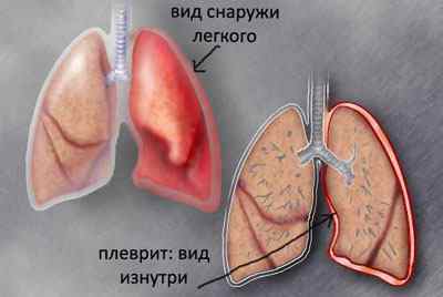 Пневмосклероз легенів: що це таке і як його лікувати