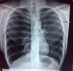 Пневмоторакс на рентгенограмі: ознаки, діагностика
