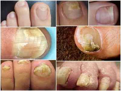 Початкова стадія грибка нігтів на ногах: фото, симптоми, лікування
