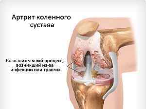 Подагра колінного суглоба: симптоми лікування подагричного артриту народними засобами, фото, біль при подагрі в коліні | Ревматолог