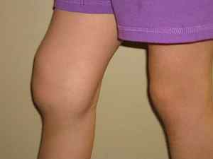 Подагра колінного суглоба: симптоми лікування подагричного артриту народними засобами, фото, біль при подагрі в коліні | Ревматолог
