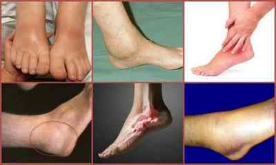 Подагра на ногах: фото, симптоми, лікування, профілактика
