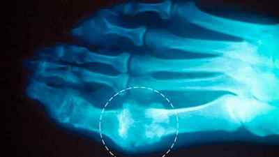 Подагричний артрит: що це таке, симптоми і лікування, народні засоби і дієта при подагричний артрит стопи | Ревматолог