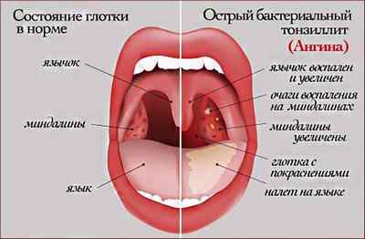 Поганий запах з горла: причини і лікування