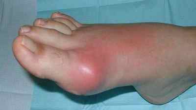 Поліартрит колінного суглоба: симптоми і лікування в домашніх умовах, фото | Ревматолог