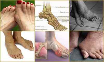 Поліартрит ніг (стопи) - симптоми і лікування