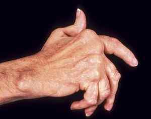 Поліартрит пальців рук: симптоми і лікування народними засобами, медикаментозне лікування препаратами | Ревматолог