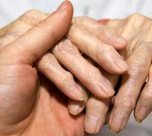 Полиостеоартроз суглобів кистей рук: лікування народними засобами і що це таке, деформуючий полиостеоартроз, дієта | Ревматолог