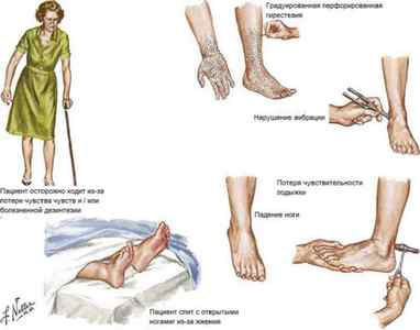 Поліневрит: що це таке, симптоми і лікування алкогольного поліневриту нижніх кінцівок | Ревматолог