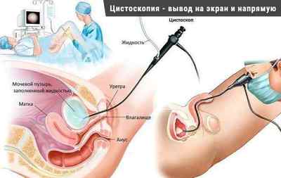 Поліп уретри у жінок: лікування, операція і відгуки