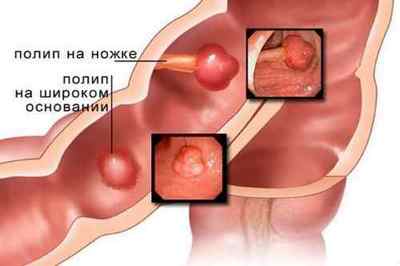 Поліпи в кишечнику: симптоми і лікування патології
