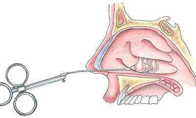 Поліпи в носі: лікування без операції