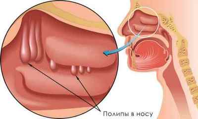 Поліпозно гайморит: лікування поліпів в пазухах