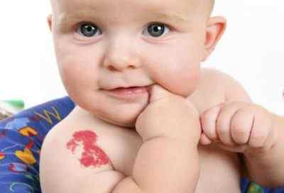 Помітили червону родимку у дитини на тілі? Як відрізнити судинний невус від висячої ангіоми і варто видаляти подібні новоутворення у дітей?