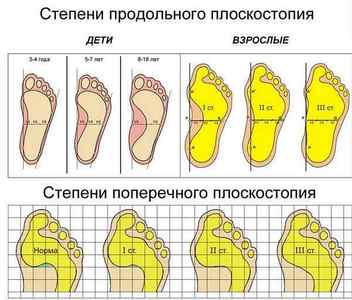 Поперечна плоскостопість: симптоми і методи лікування