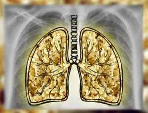 Попкорнового хвороба легень: симптоми, ознаки, лікування