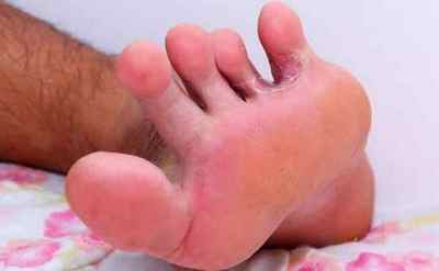 Попрілості між пальцями ніг (лікування і профілактика)