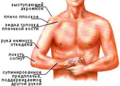 Пошкодження Хілл-Сакса плечового суглоба: лікування імпресійної і з | Ревматолог