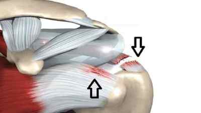 Пошкодження обертальної манжети плечового суглоба: лікування, розрив мяза ротаторної манжети плеча, анатомія | Ревматолог