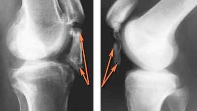 Пошкодження задньої хрестоподібної звязки колінного суглоба: лікування розриву і ангуляції, звязка ангулірована що це означає | Ревматолог