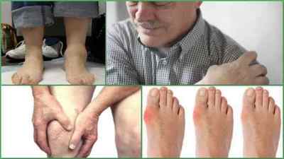 Посттравматичний артрит гомілковостопного, колінного суглобів: симптоми і лікування
