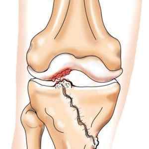 Посттравматичний артрит колінного і гомілковостопного суглобів: лікування 3 ступеня, МКБ 10 травматичний артрит | Ревматолог
