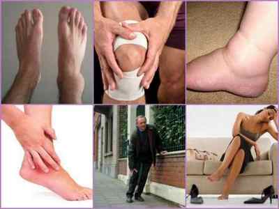 Посттравматичний артроз гомілковостопного і гонартроз колінного суглобів