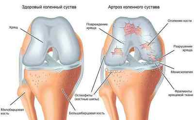 Посттравматичний артроз гомілковостопного, колінного і плечового суглоба: симптоми і лікування, травматичний артроз | Ревматолог