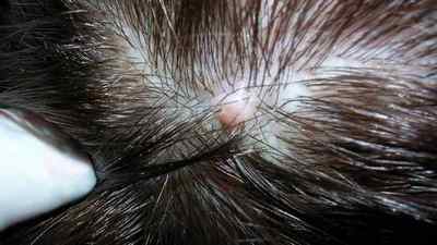 Правильна діагностика і лікування фурункула на голові: приклад на фото