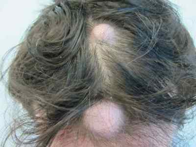 Правильна діагностика і лікування фурункула на голові: приклад на фото