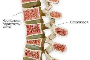 Препарати кальцію для профілактики остеопорозу: які препарати кальцію краще при остеопорозі у жінок | Ревматолог