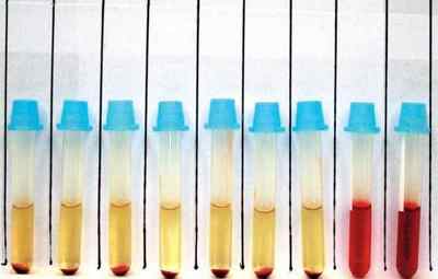 Причини гемолізу еритроцитів при здачі аналізів крові