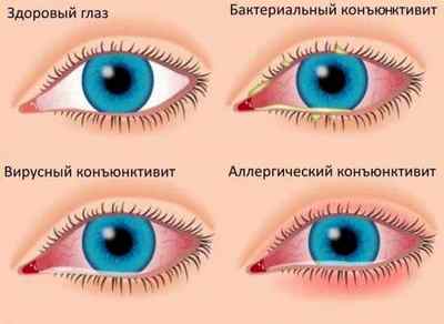 Причини конюнктивіту очей у дорослих: лікування, фактори ризику, що провокують захворювання
