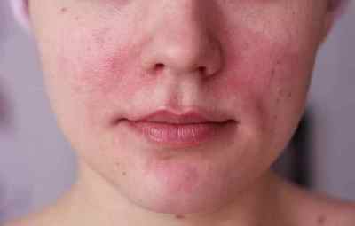 Причини і лікування купероза на обличчі
